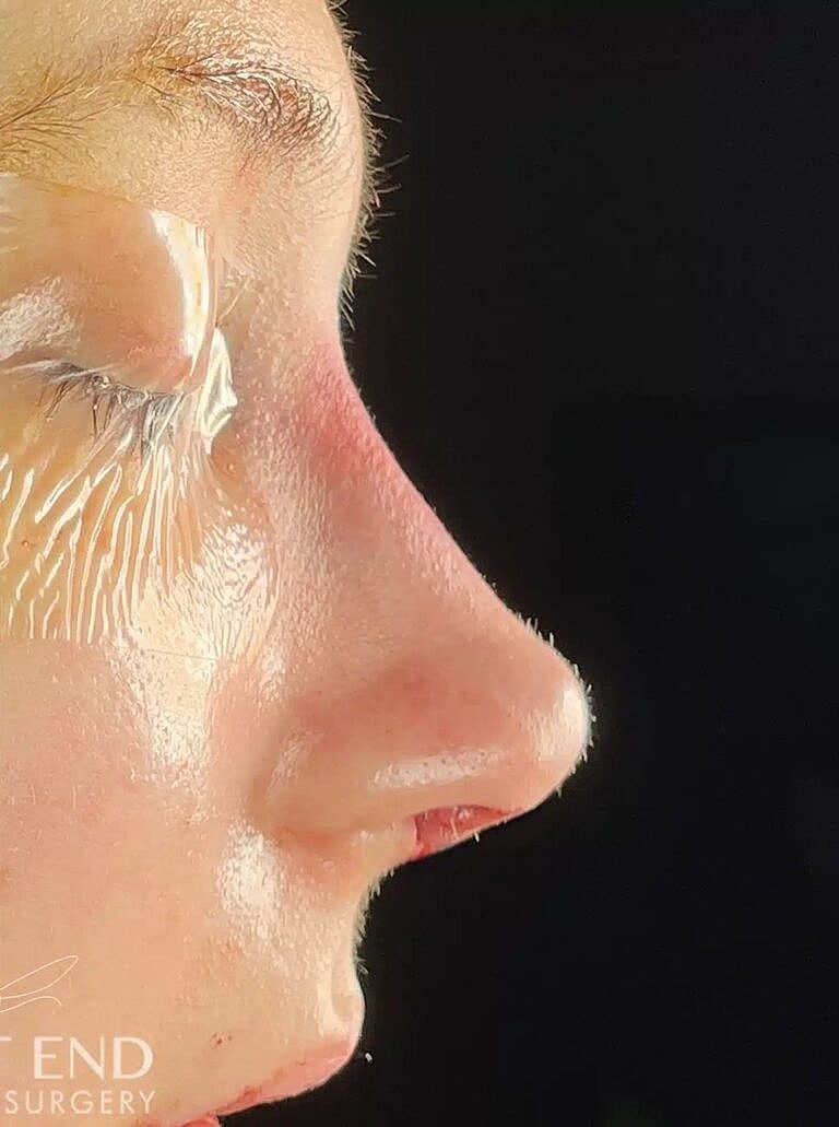 Nose Job Rhinoplasty Before & After