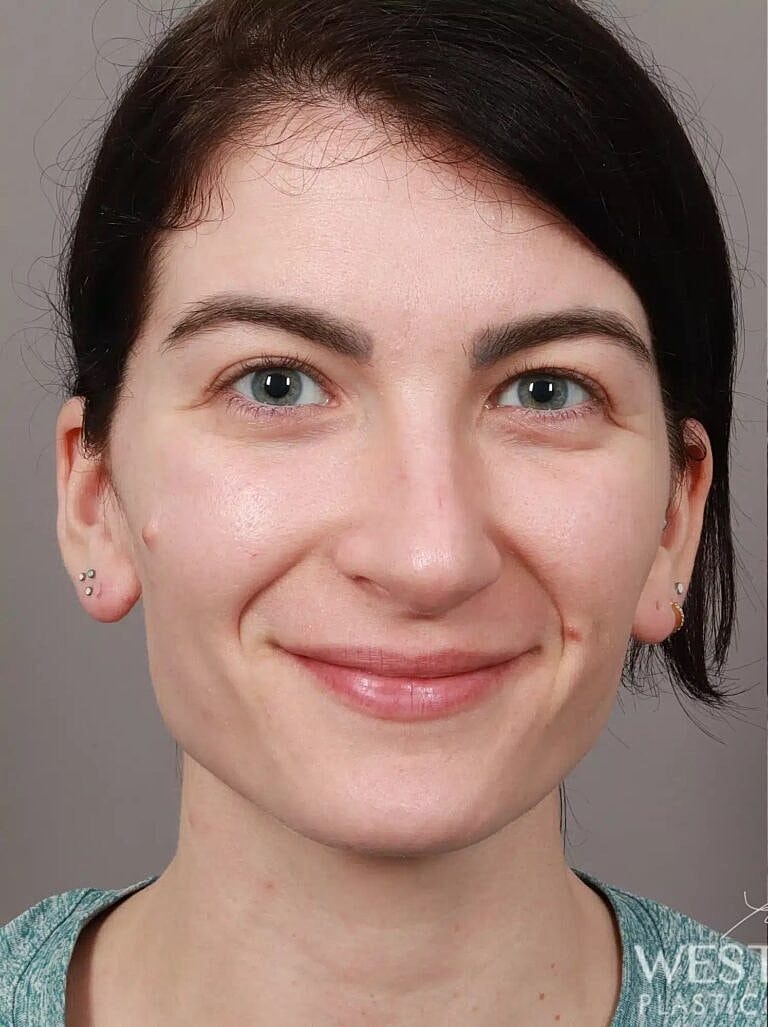 Nose Job Rhinoplasty Before & After