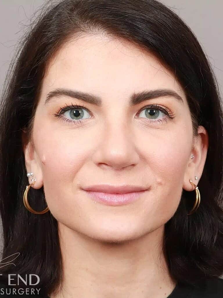 Nose Job Rhinoplasty Before & After