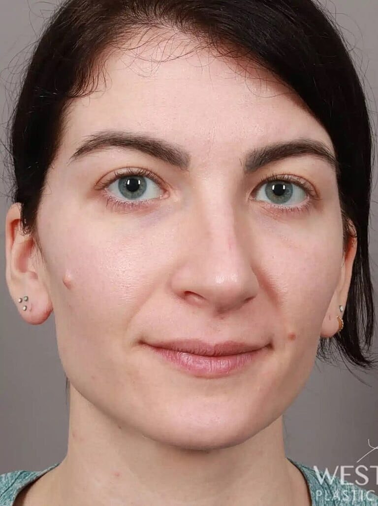 Nose Job Rhinoplasty Before & After