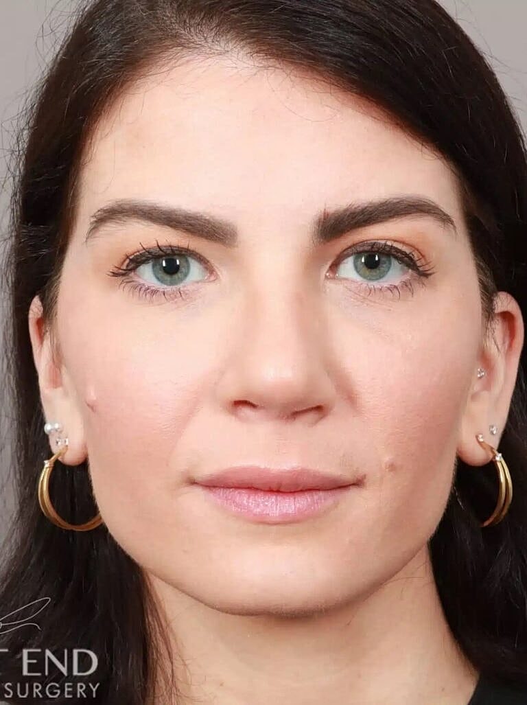 Nose Job Rhinoplasty Before & After