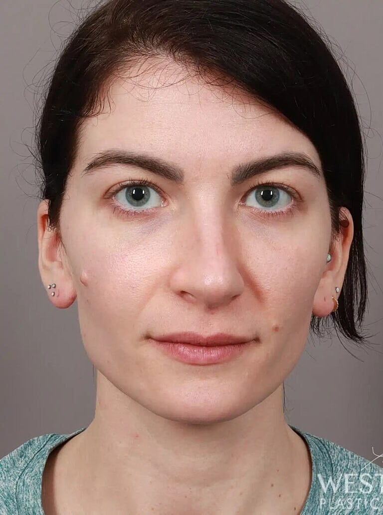 Nose Job Rhinoplasty Before & After