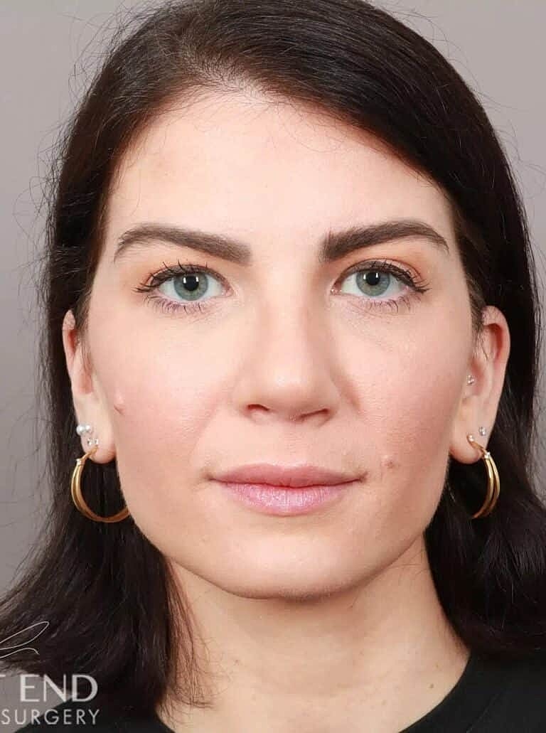 Nose Job Rhinoplasty Before & After