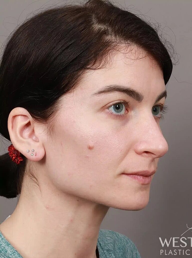 Nose Job Rhinoplasty Before & After