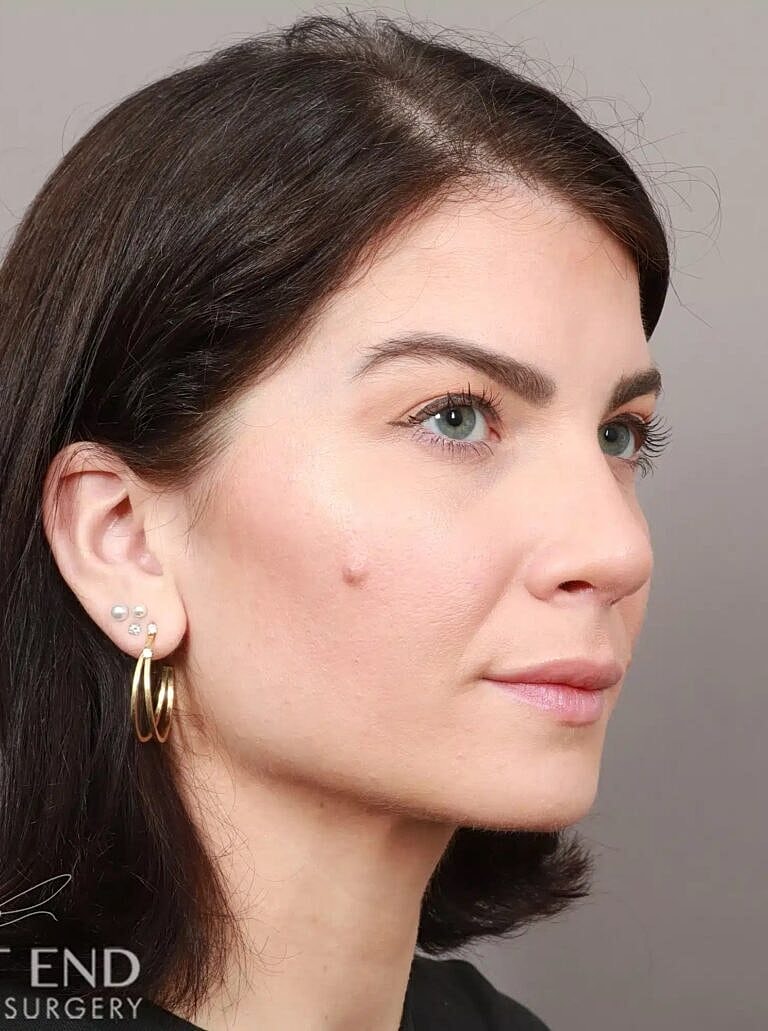 Nose Job Rhinoplasty Before & After