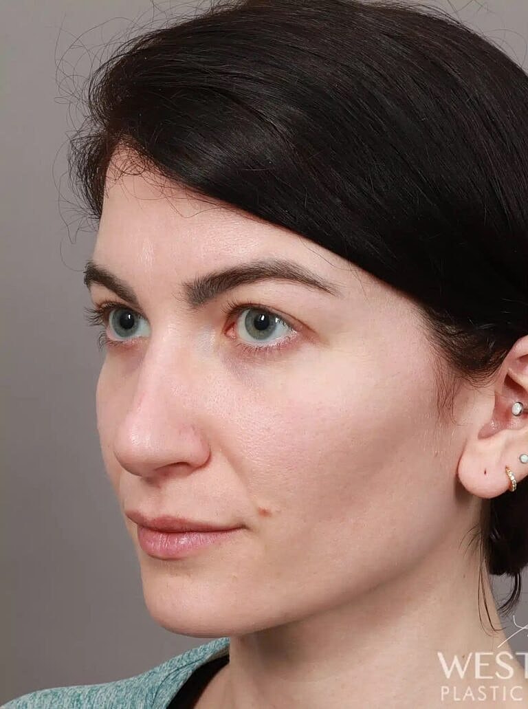 Nose Job Rhinoplasty Before & After