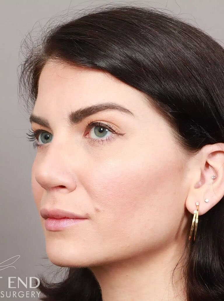 Nose Job Rhinoplasty Before & After