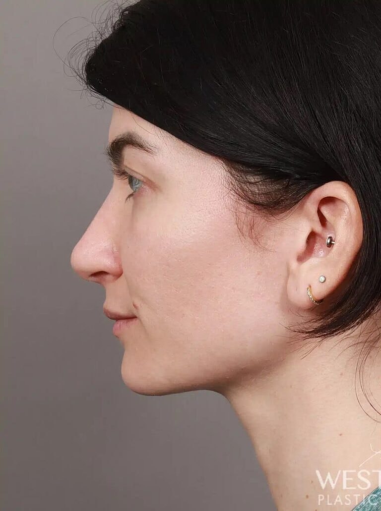 Nose Job Rhinoplasty Before & After