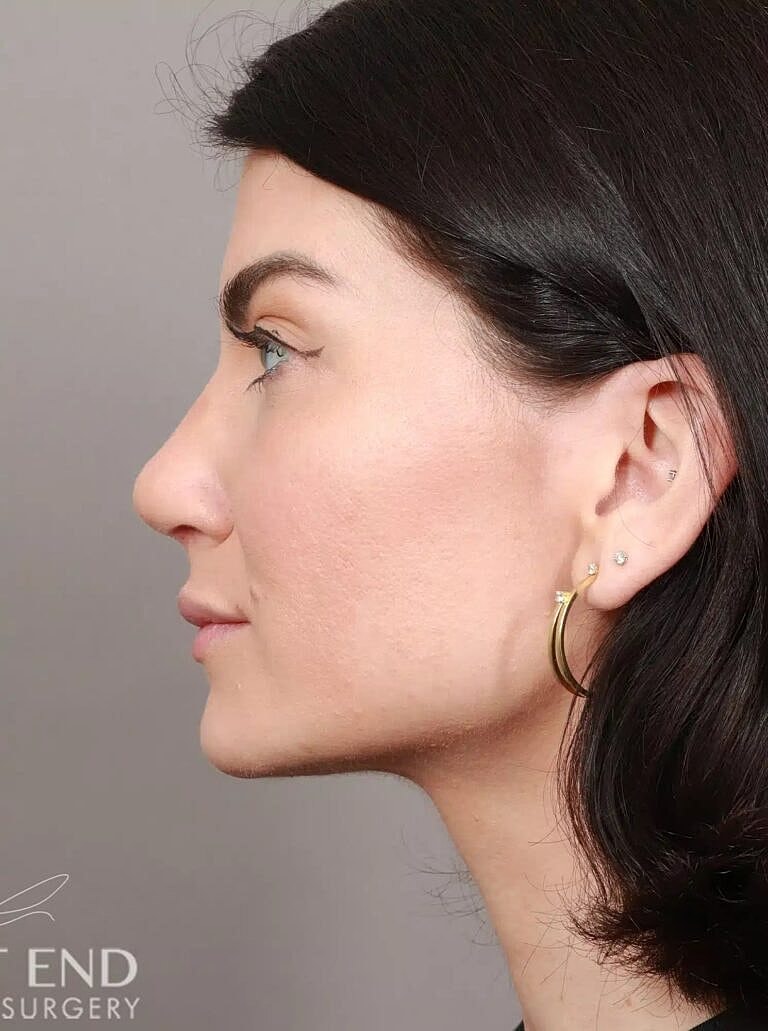 Nose Job Rhinoplasty Before & After
