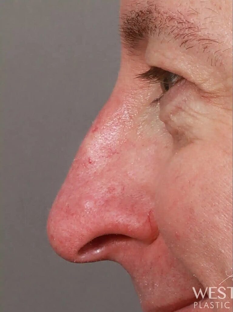 Nose Job Rhinoplasty Before & After