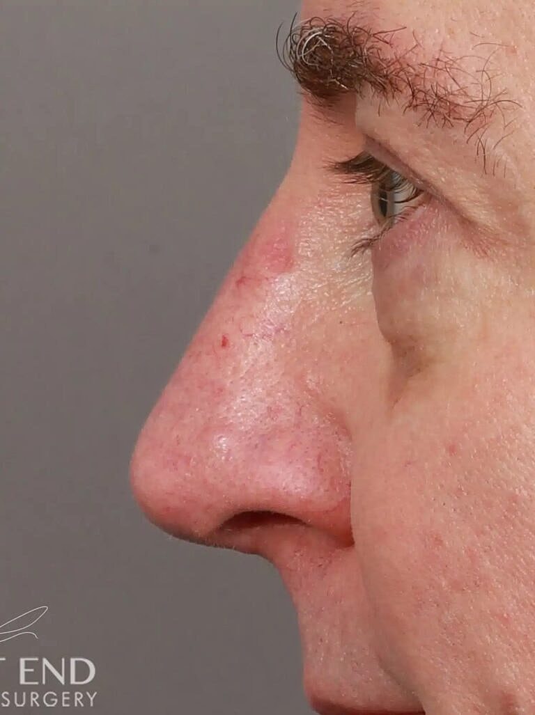 Nose Job Rhinoplasty Before & After