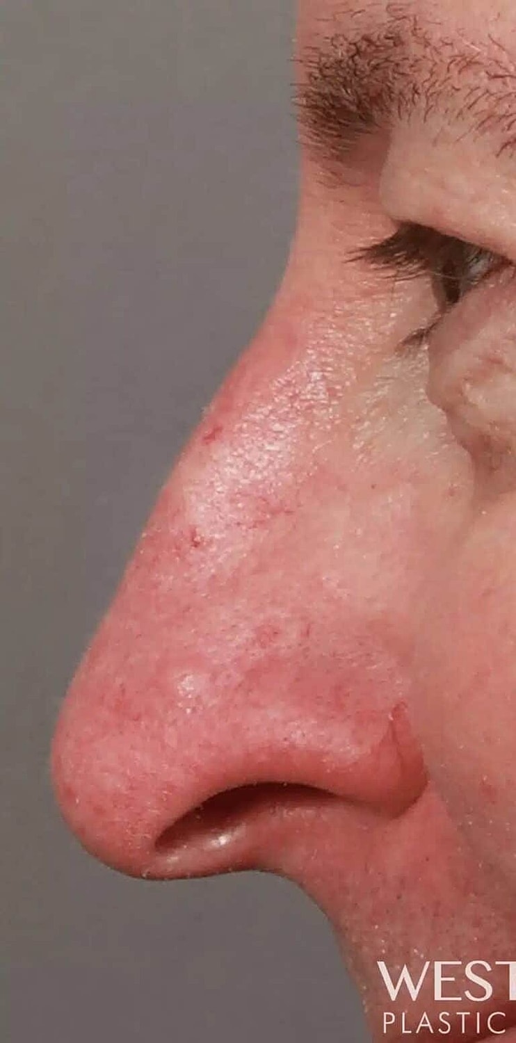 Nose Job Rhinoplasty Before & After