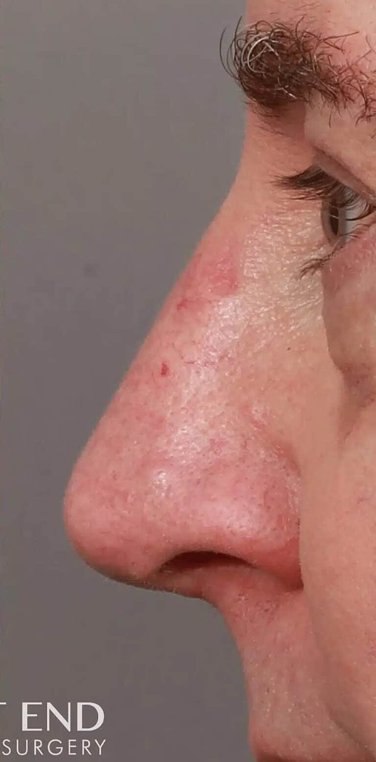 Nose Job Rhinoplasty Before & After