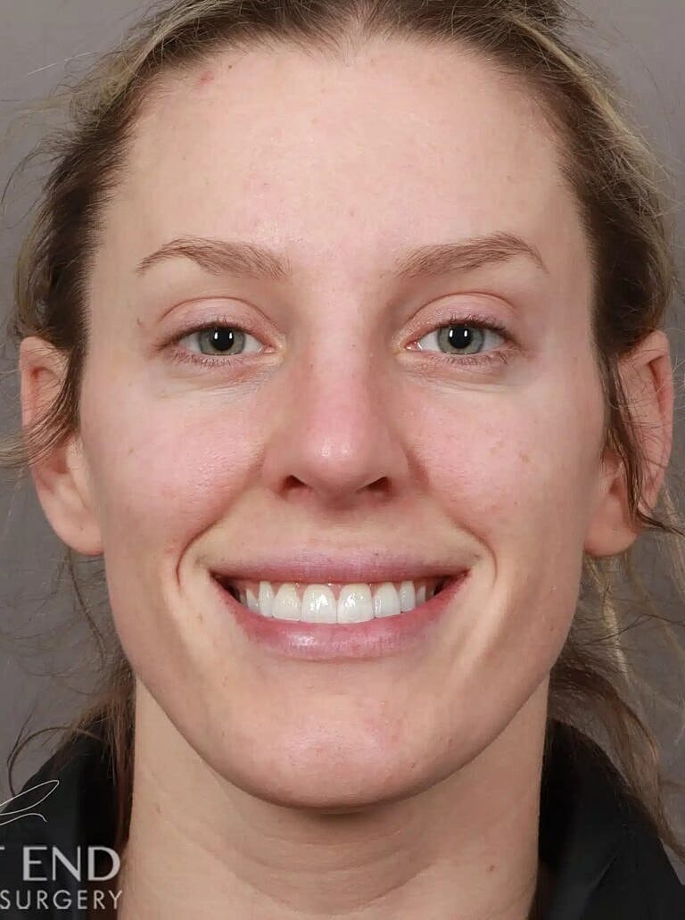 Nose Job Rhinoplasty Before & After