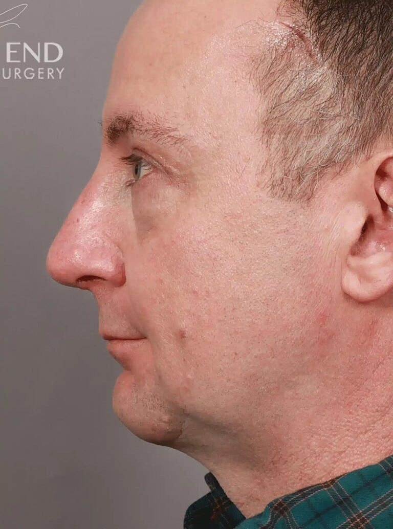 Nose Job Rhinoplasty Before & After
