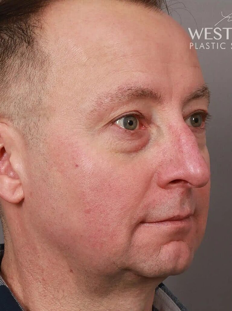 Nose Job Rhinoplasty Before & After