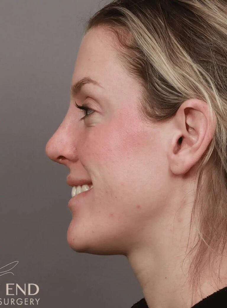 Nose Job Rhinoplasty Before & After