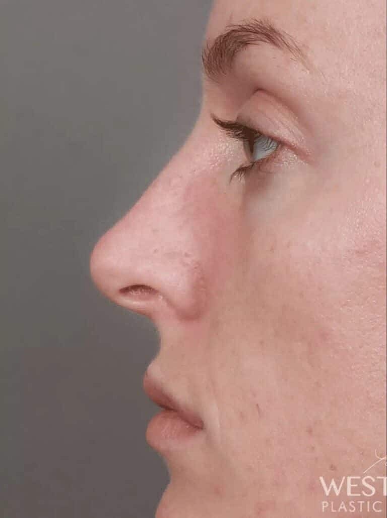 Nose Job Rhinoplasty Before & After