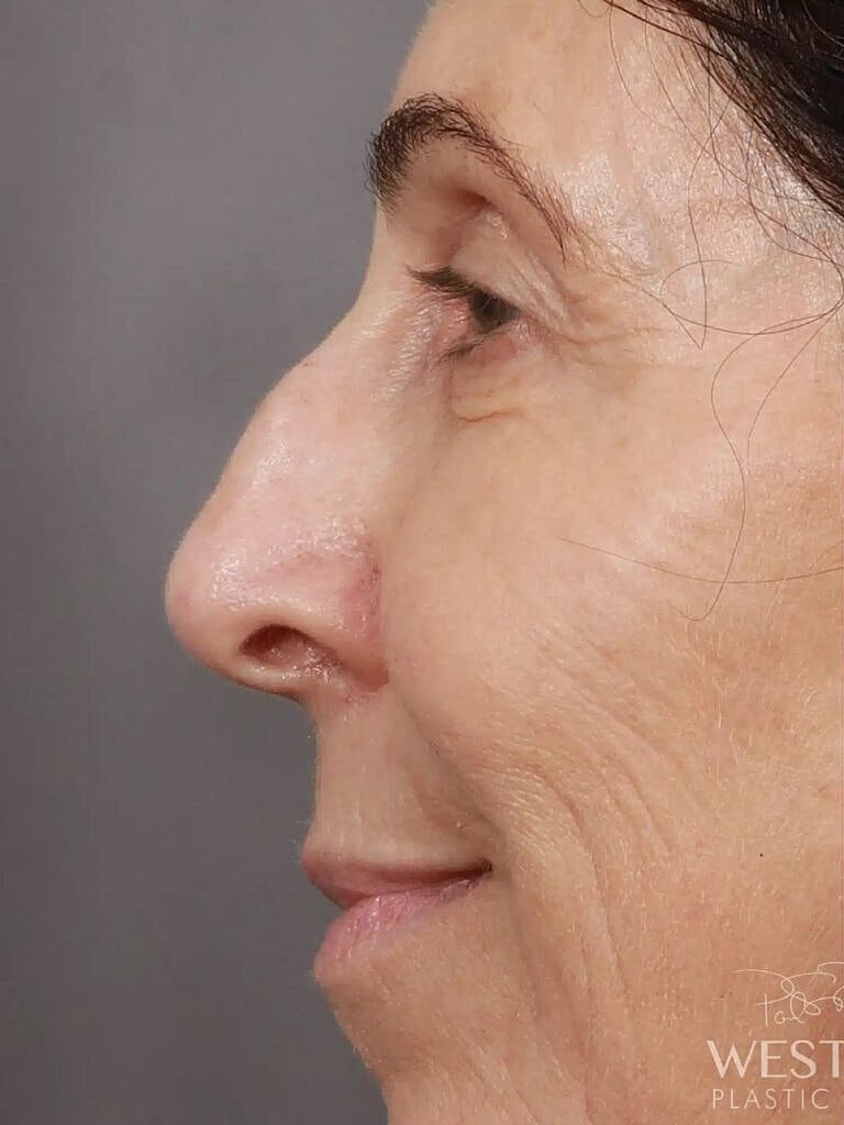 Nose Job Rhinoplasty Before & After