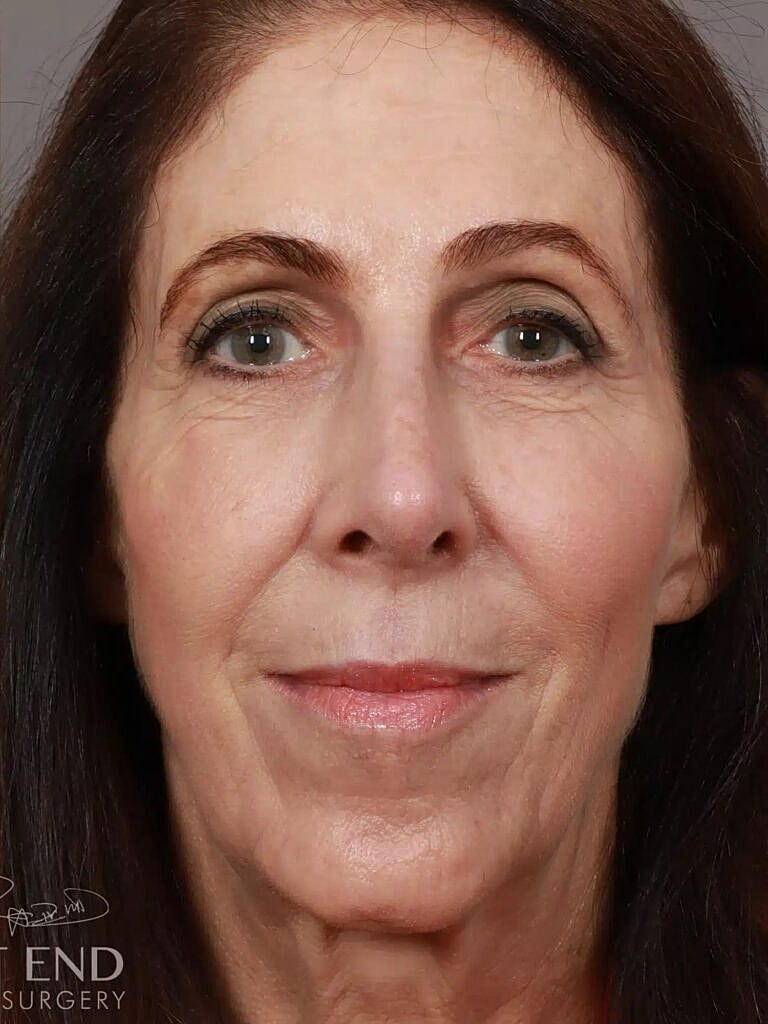 Nose Job Rhinoplasty Before & After