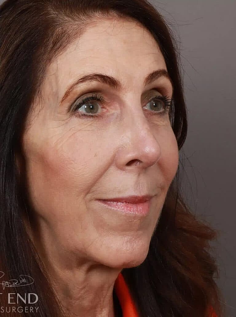 Nose Job Rhinoplasty Before & After