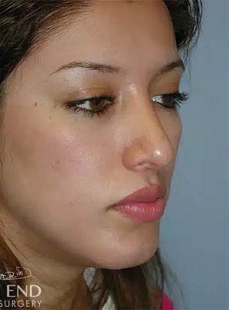 Nose Job Rhinoplasty Before & After
