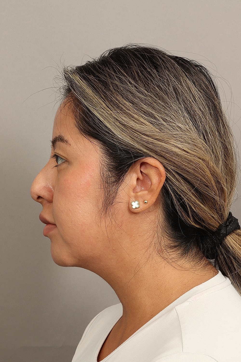 Nose Job Rhinoplasty Before & After