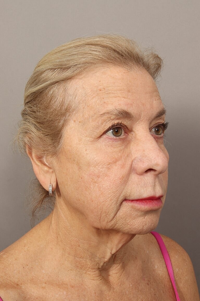 Blepharoplasty Before & After
