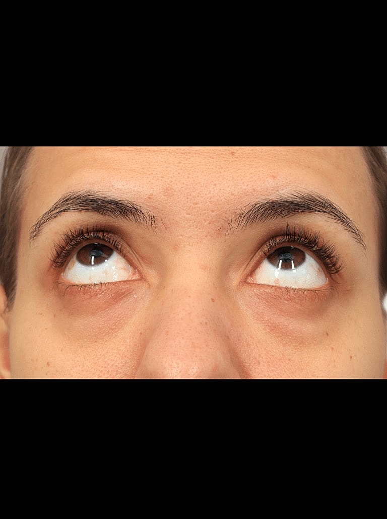 Blepharoplasty Before & After