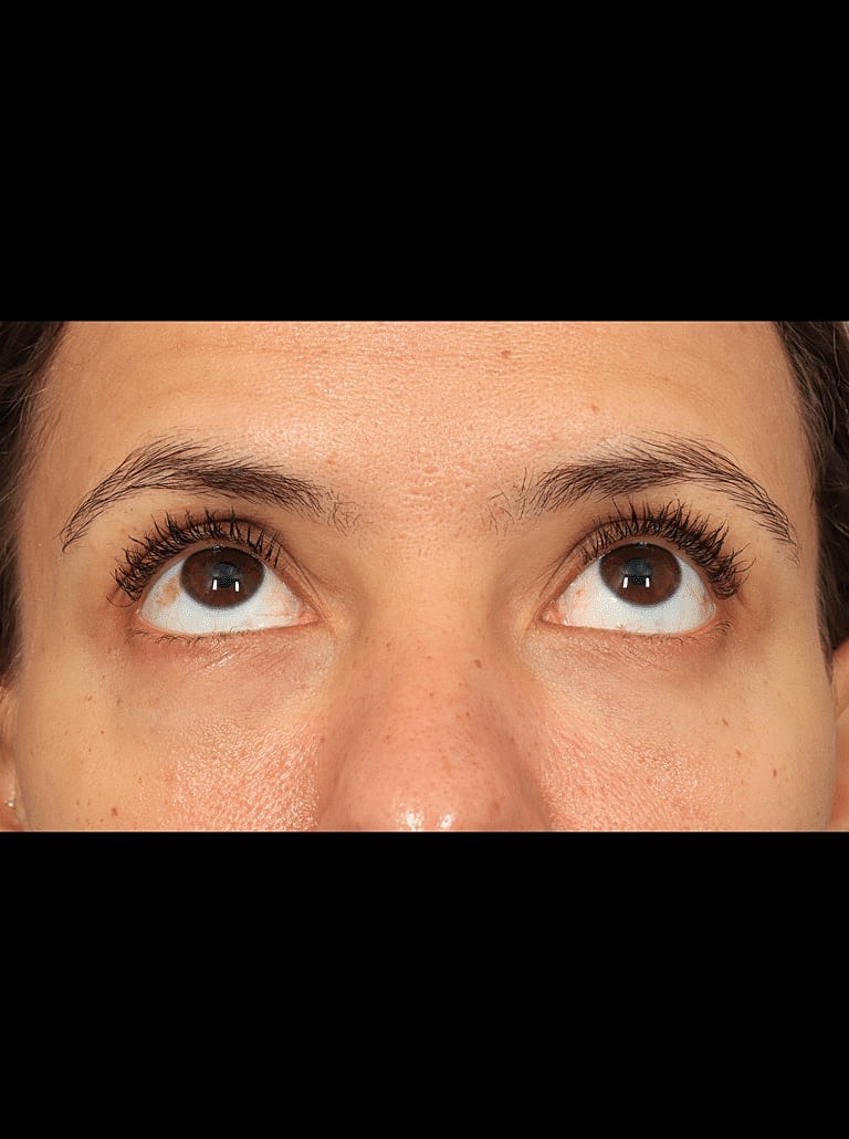 Blepharoplasty Before & After