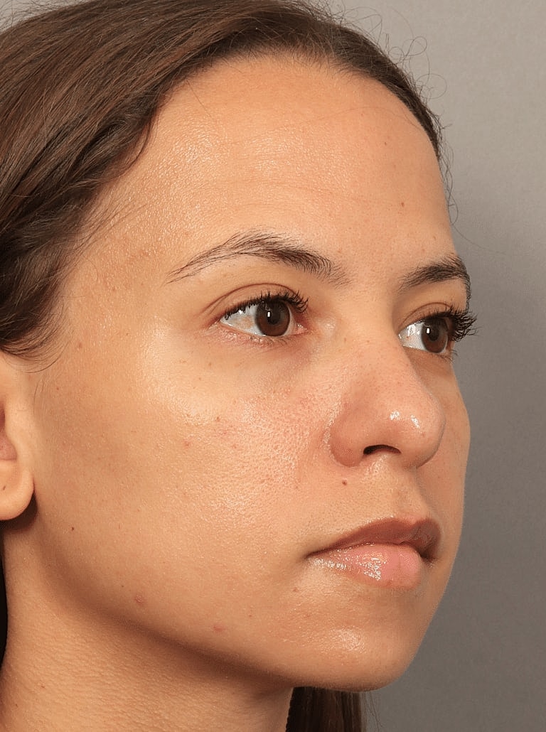 Blepharoplasty Before & After