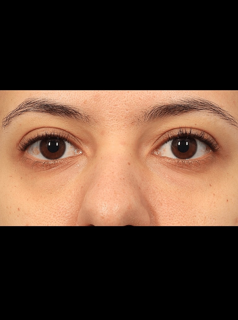 Blepharoplasty Before & After