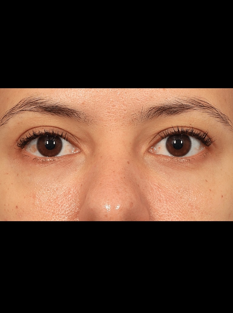Blepharoplasty Before & After