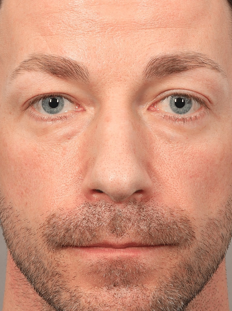 Blepharoplasty Before & After