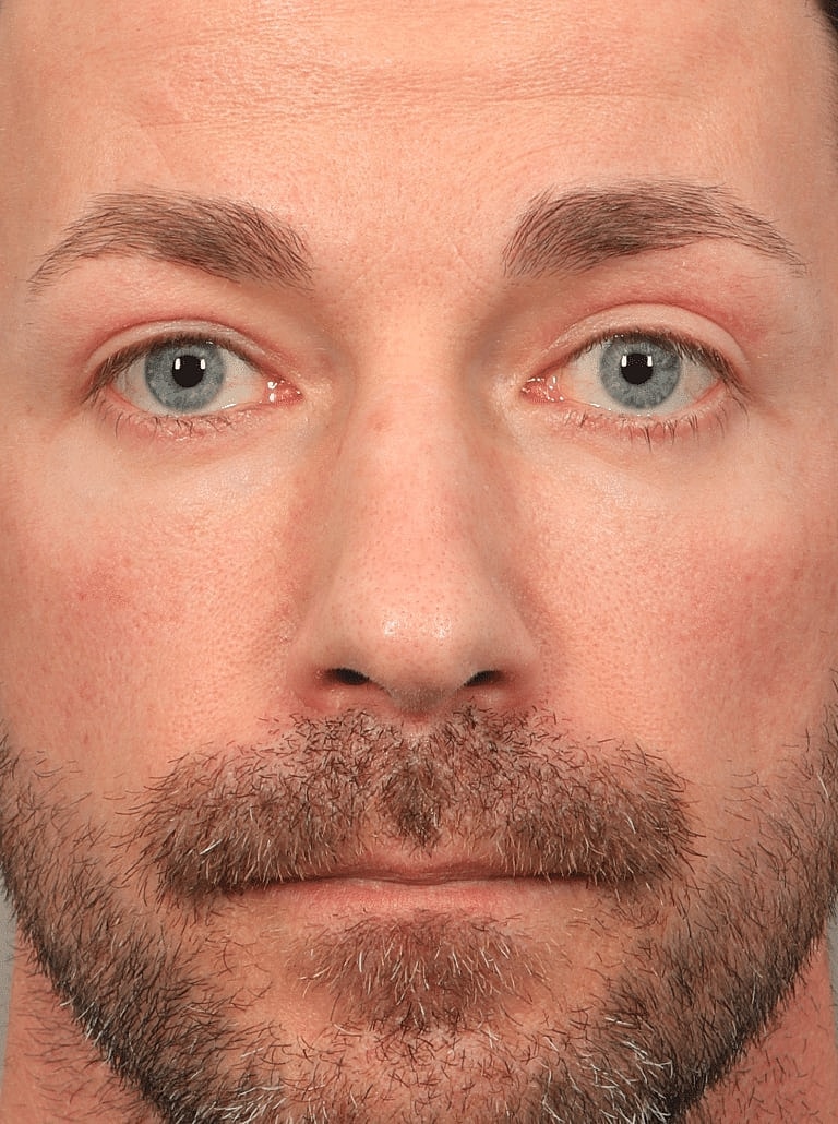 Blepharoplasty Before & After