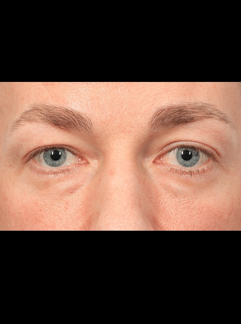 Blepharoplasty Before & After
