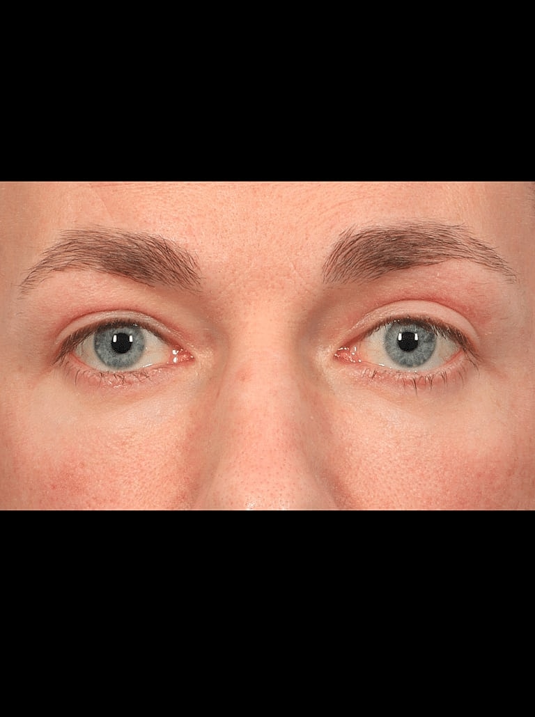 Blepharoplasty Before & After