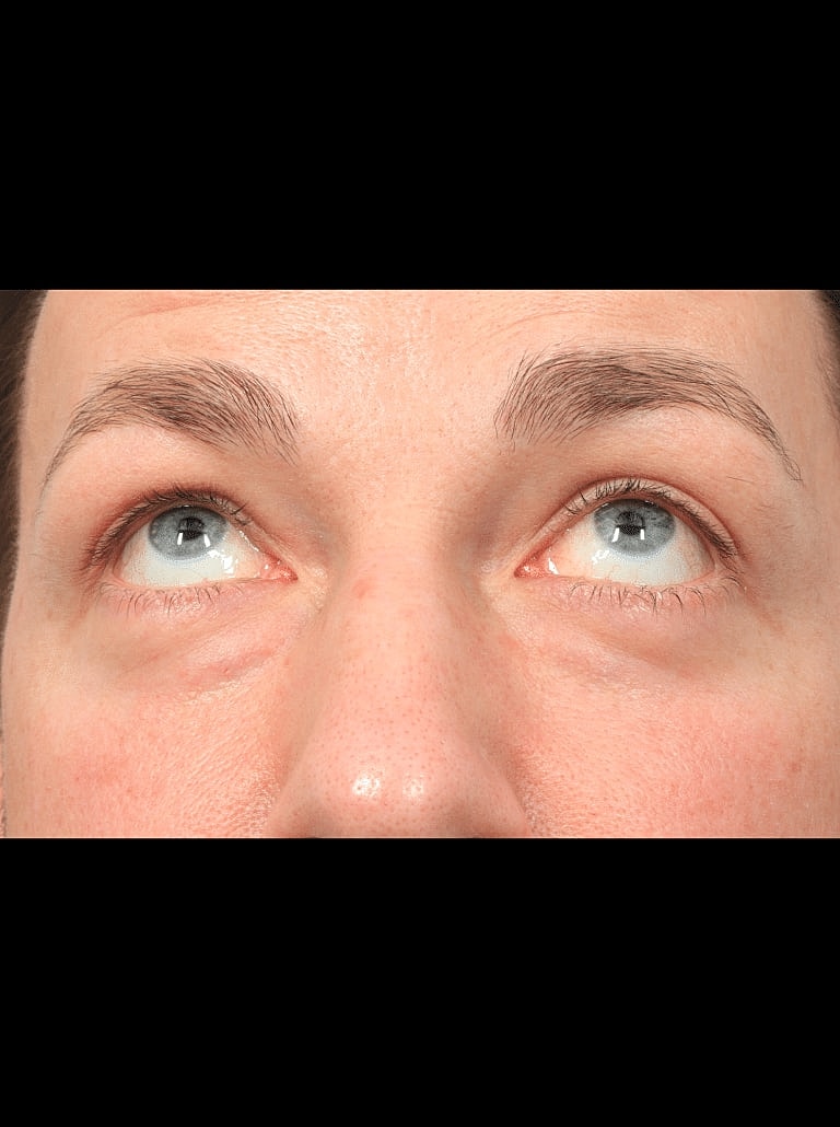 Blepharoplasty Before & After