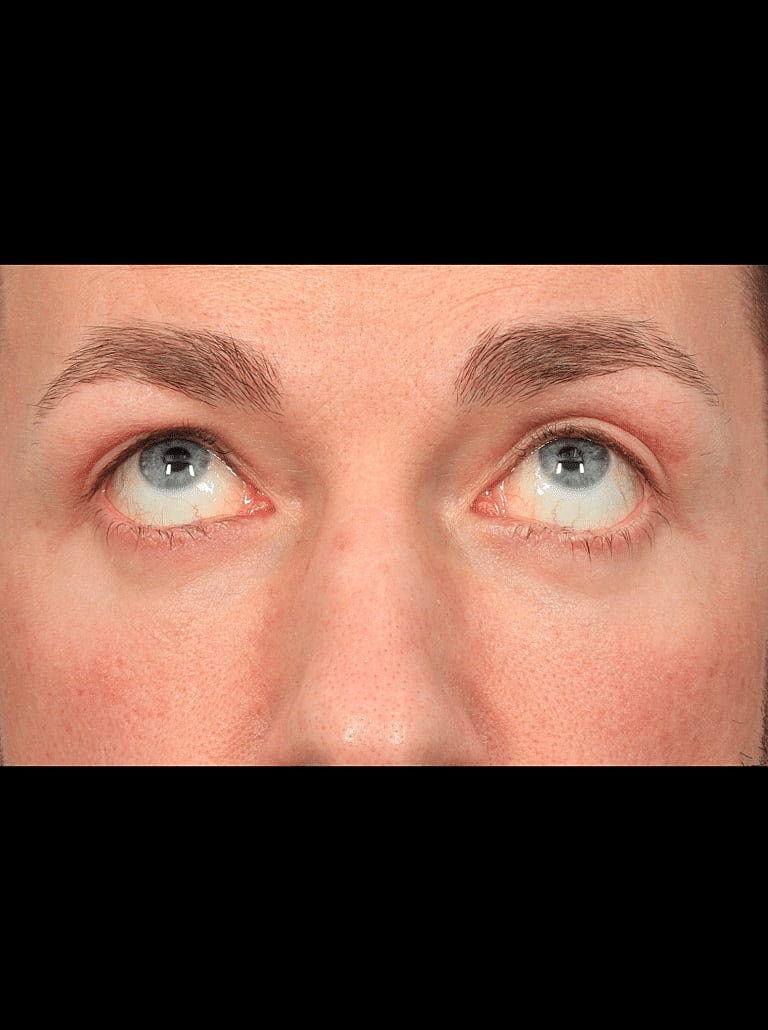 Blepharoplasty Before & After