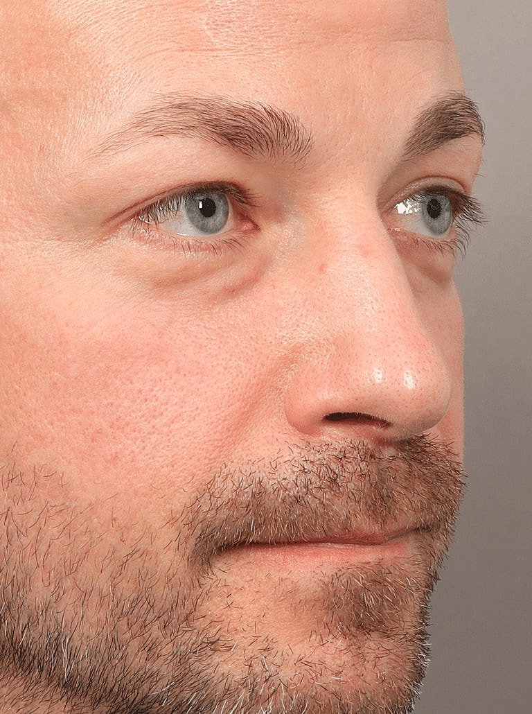 Blepharoplasty Before & After