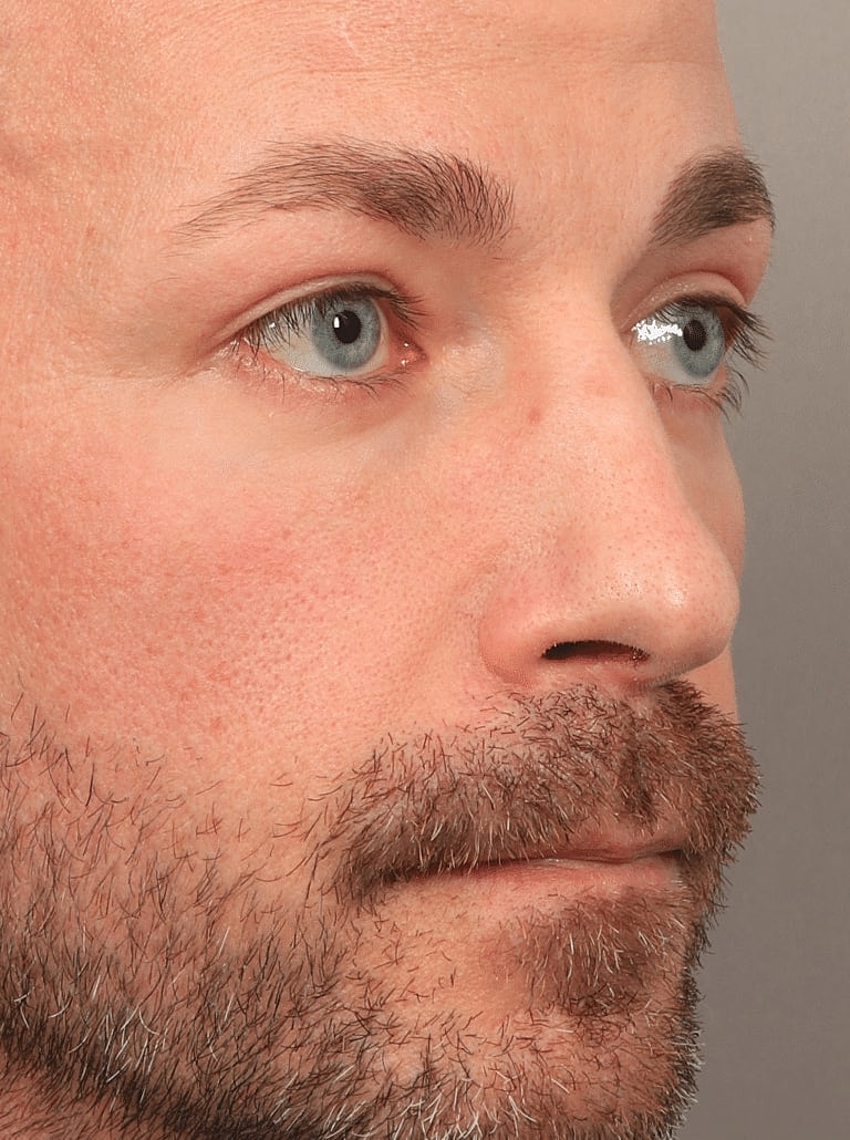 Blepharoplasty Before & After