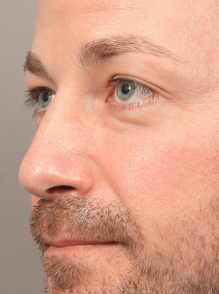Blepharoplasty Before & After