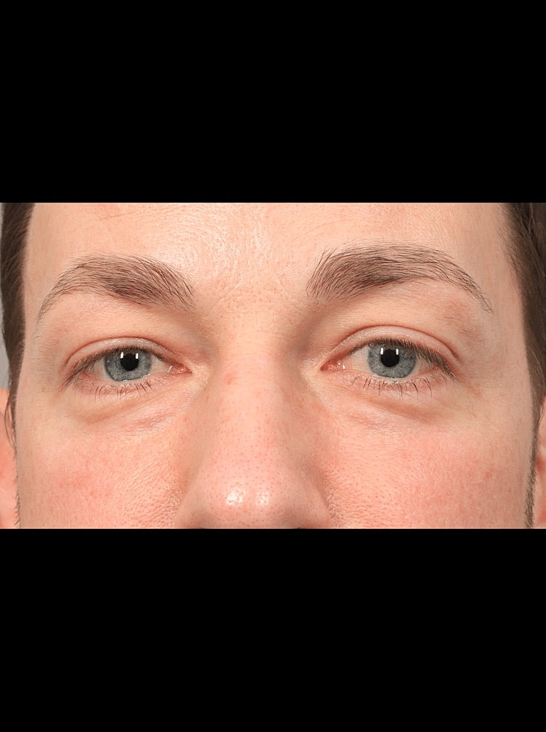 Blepharoplasty Before & After