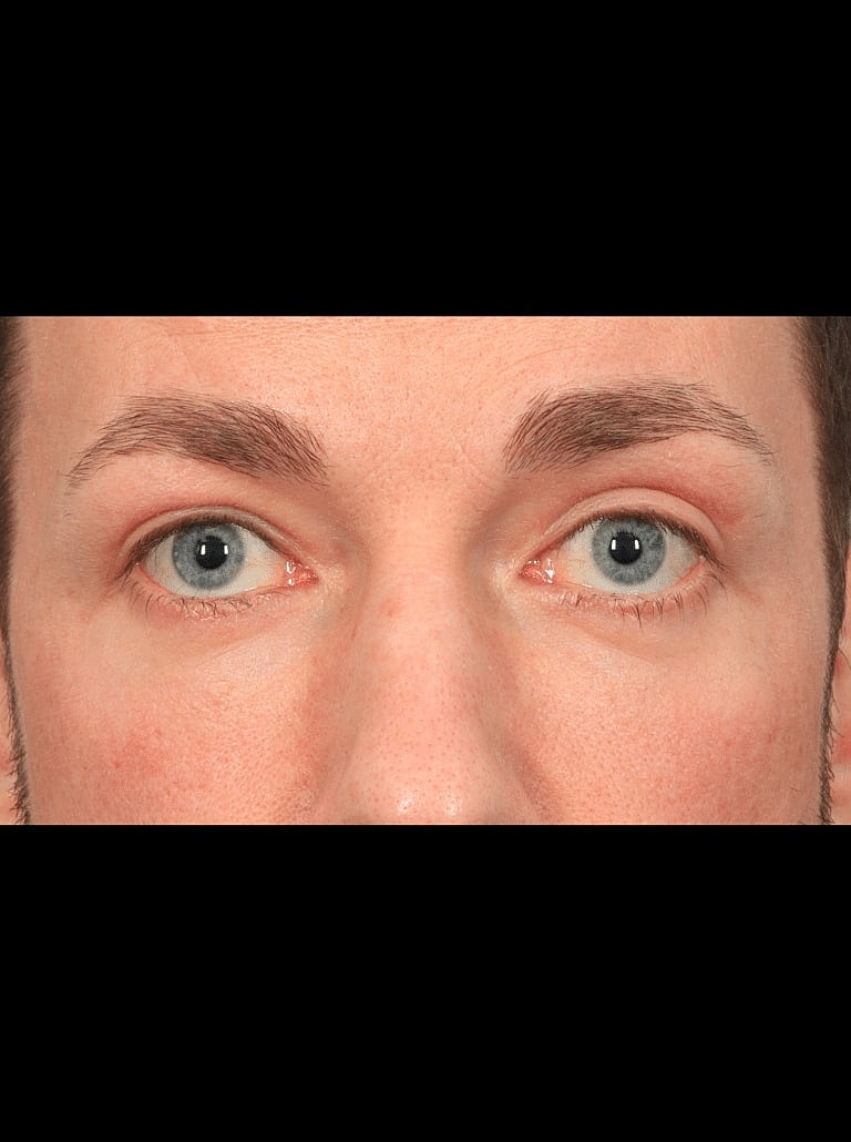 Blepharoplasty Before & After