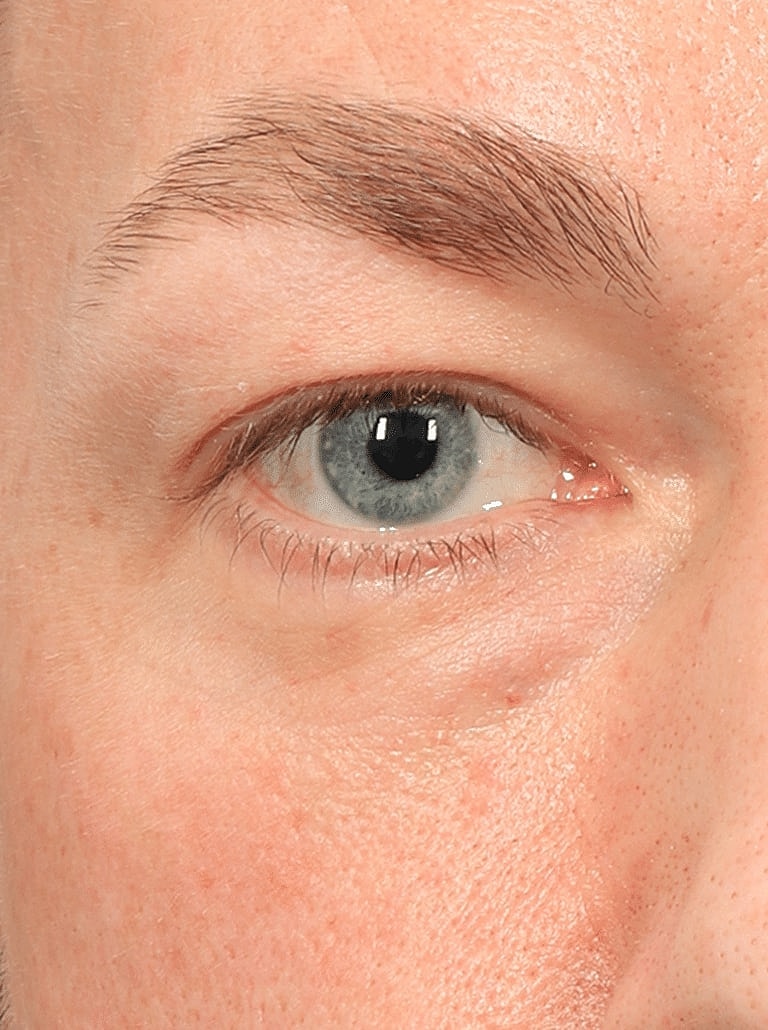 Blepharoplasty Before & After