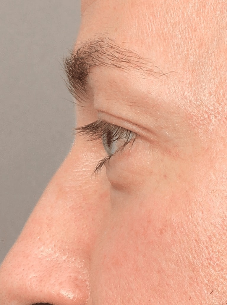 Blepharoplasty Before & After