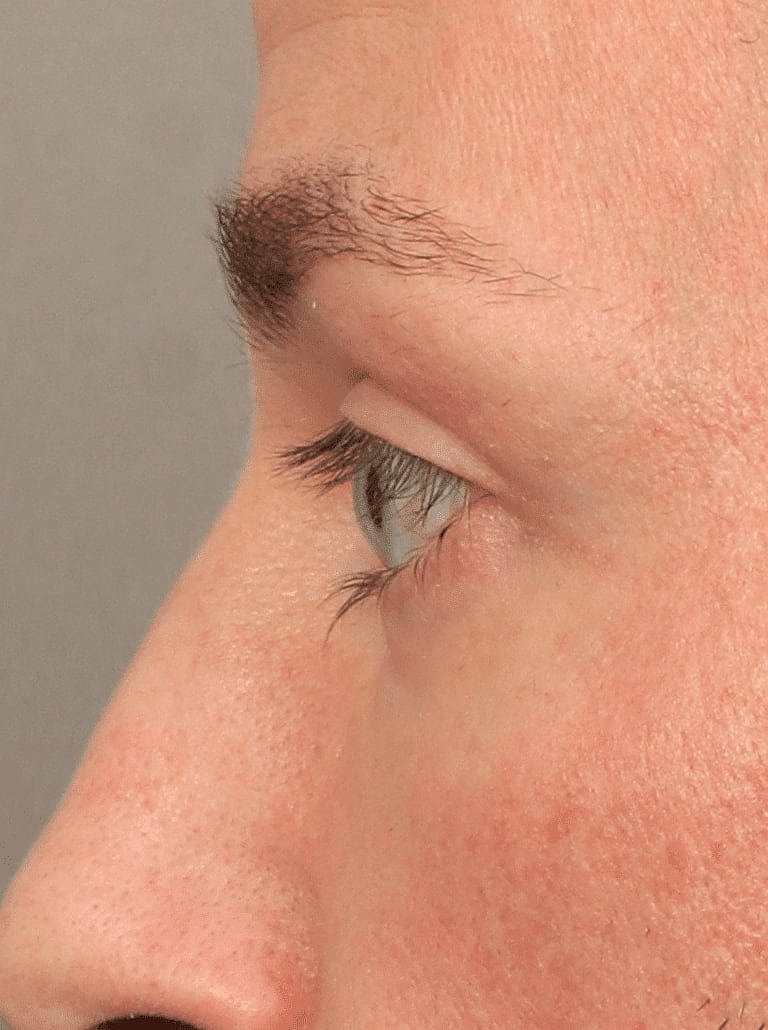 Blepharoplasty Before & After