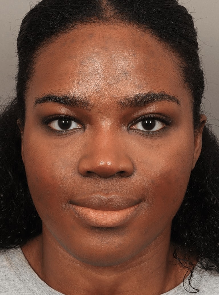 Blepharoplasty Before & After