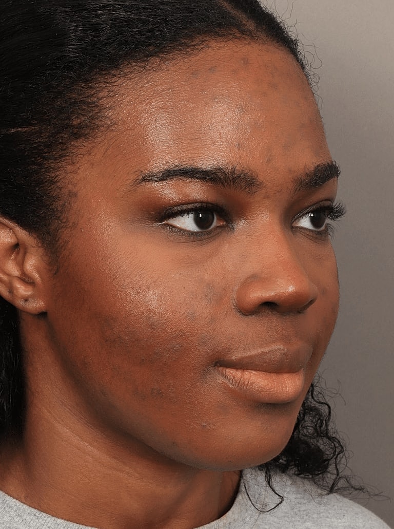 Blepharoplasty Before & After