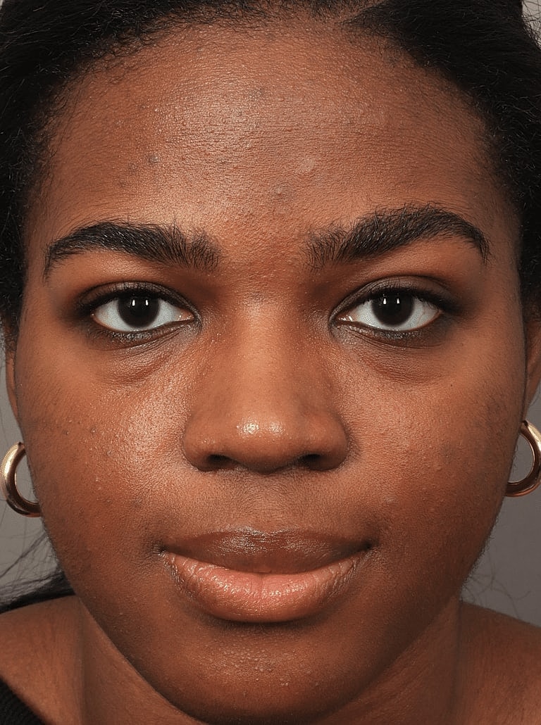 Blepharoplasty Before & After